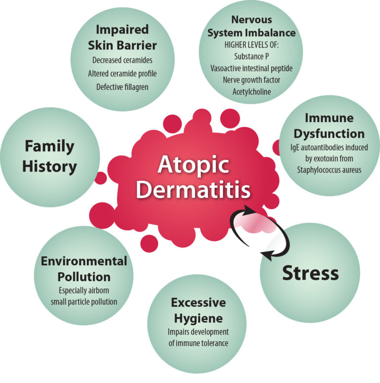 Graphic showing causes or irritants leading to Atopic Dermatitis. Each cause is in its own circle surrounding the main title of "Atopic Dermatitis. Causes are: Excessive Hygiene: Impairs development of immune tollerance; Environmental Pollution: Especially airborn small particle pollution; Family History; Impaired Skin Barrier: Decreased ceramides, Altered ceramide profile, defective fillagren; Nervous System Imbalance: Higher levels of: Substance P, Vasoactive intestinal peptide, nerve growth factor, acetylcholine; Immune Dysfunction: IgE autoantibodies induced by exotoxin from Staphylococcus aureus; and Stress. There is a circular arrow between stress and Atopic Dermatitiis showing that each effects the other.